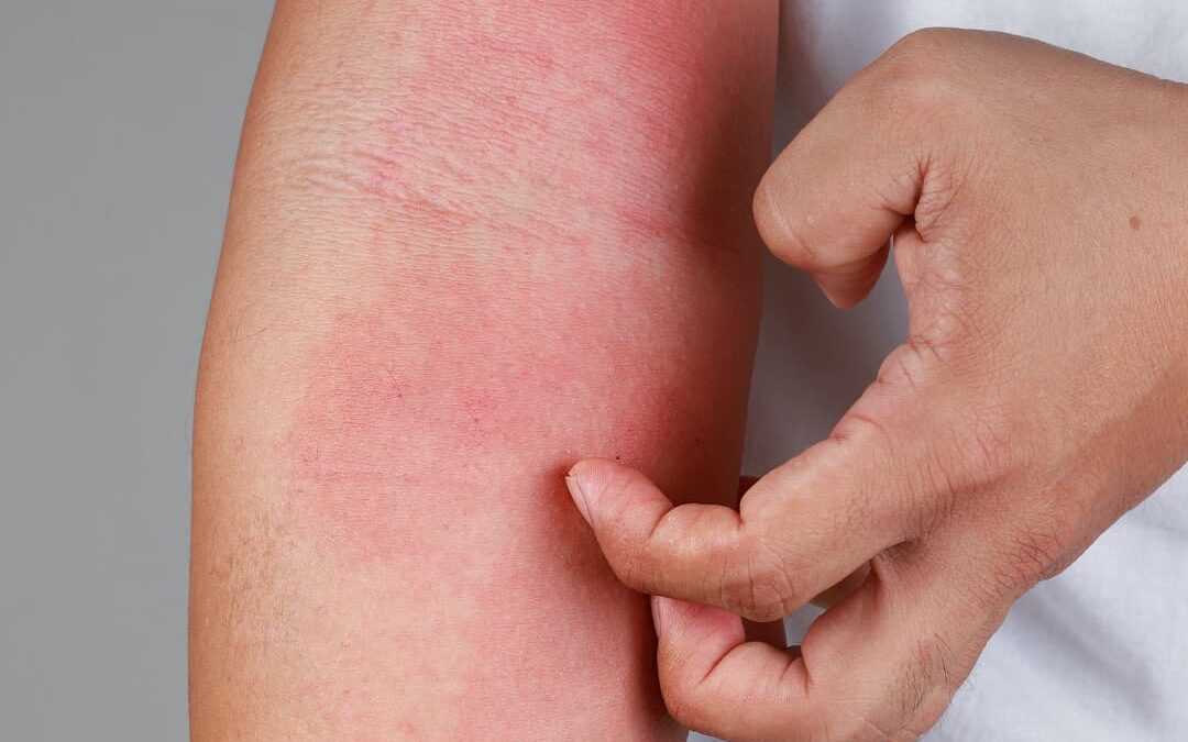 Alergias en bebés, ¿qué tienes que saber?
